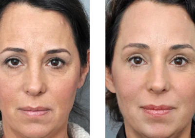 Le résultat du Brow Lift pratiqué sur une femme adulte