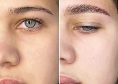 Résultat du Brow Lift pratiqué sur une jeune femme